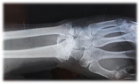 Wrist X-Ray Case Study